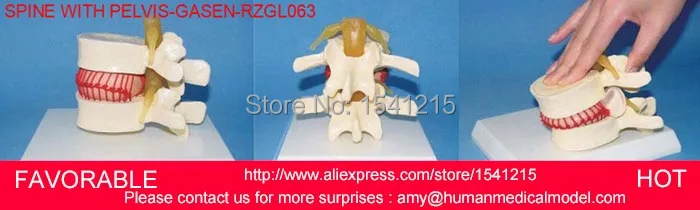 

LUMBAR MODEL SPINAL NERVE MODEL CAUDAL EQUINA NERVE LUMBAR SPINE DISC MODEL SPINE ,LUMBAR DISC HERNIATION MODELGASEN-RZGL065