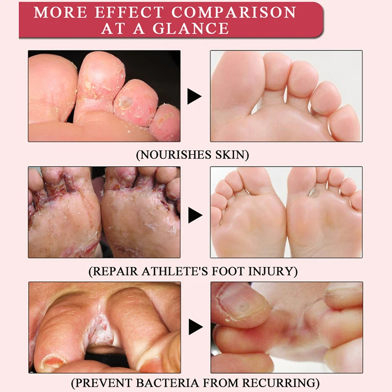 Травяное лечение ног против грибковой инфекции onychomicosis Paronychia эффективное лечение грибка ног Крем для восстановления ног Уход за ногами