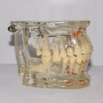 

Dental Pathology Tooth Model with Implant