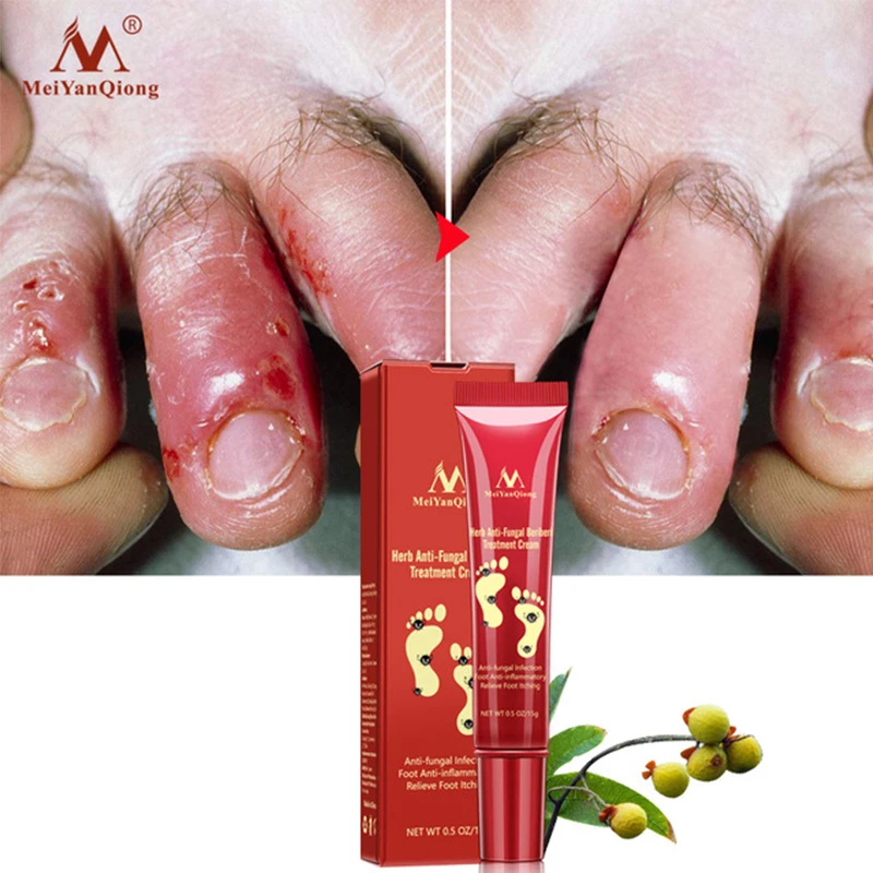 

MeiYanQiong Foot Cream Herbal Anti Fungal Relieve Beriberi Cream Feet Care Chinese Foot Cream Treatment Anti Fungal Infection