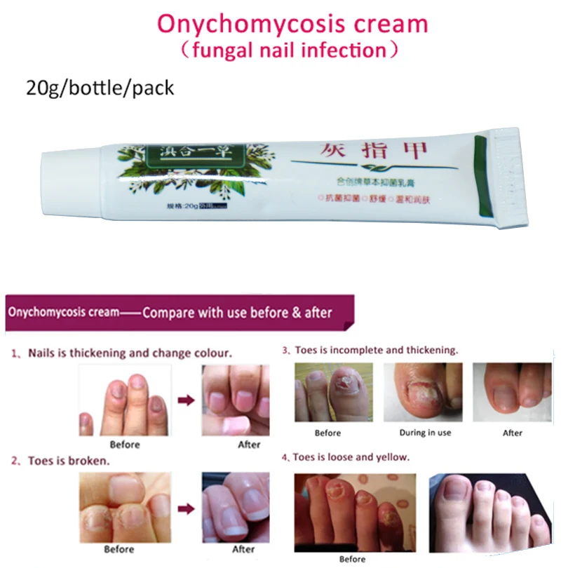 Buy 1pack Onychomycosis cream Nail Fungus Cream, nail