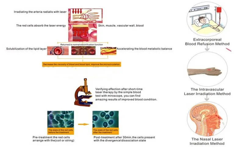 18 лазерных диодов наручные часы для лечения гипервязкости, гиперлипидемии и диабета