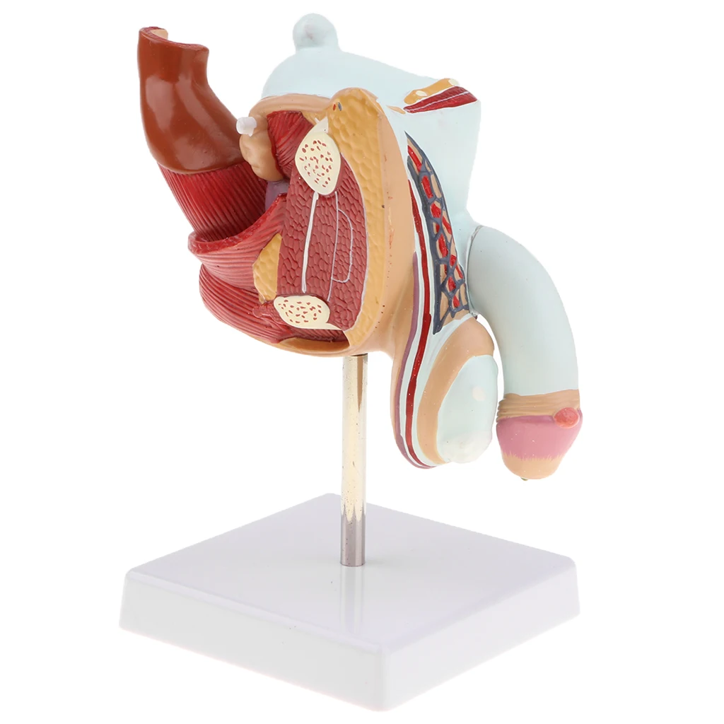 1:1 Human Male Reproduction Urinary System Pathlology Model Gonorrhea Ureteral Calculus Display Medical Study Lab Supplies