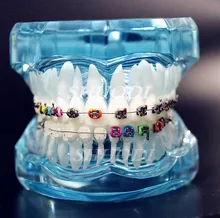 Transparent Dental Orthodontic Mallocclusion Model with Brackets Archwire buccal tube Tooth Extraction for Patient Communication Transparent Dental Orthodontic Mallocclusion Model with Brackets Archwire buccal tube Tooth Extraction for Patient Communication