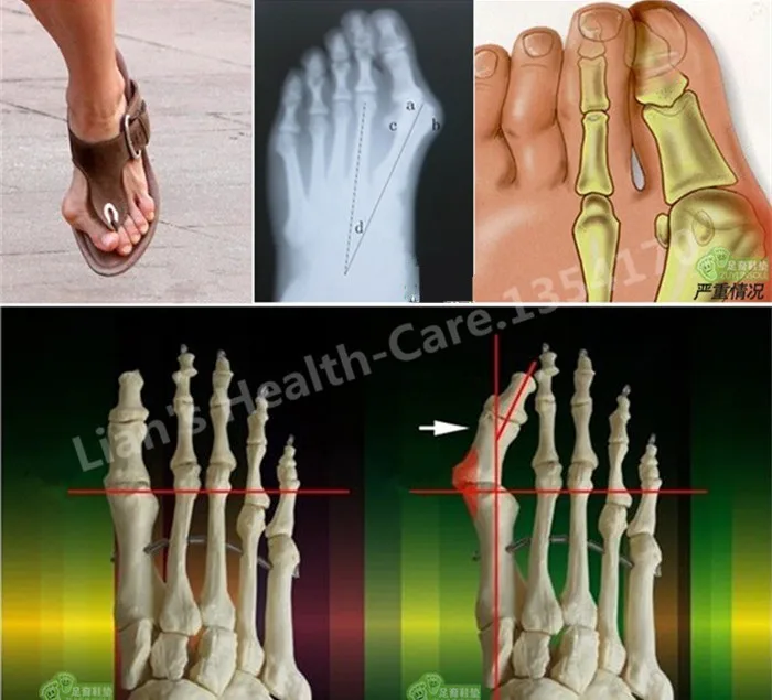 Безопасный медицинский силикагель для пальцев ног Fisioterapia Tacones Hallux корректор
