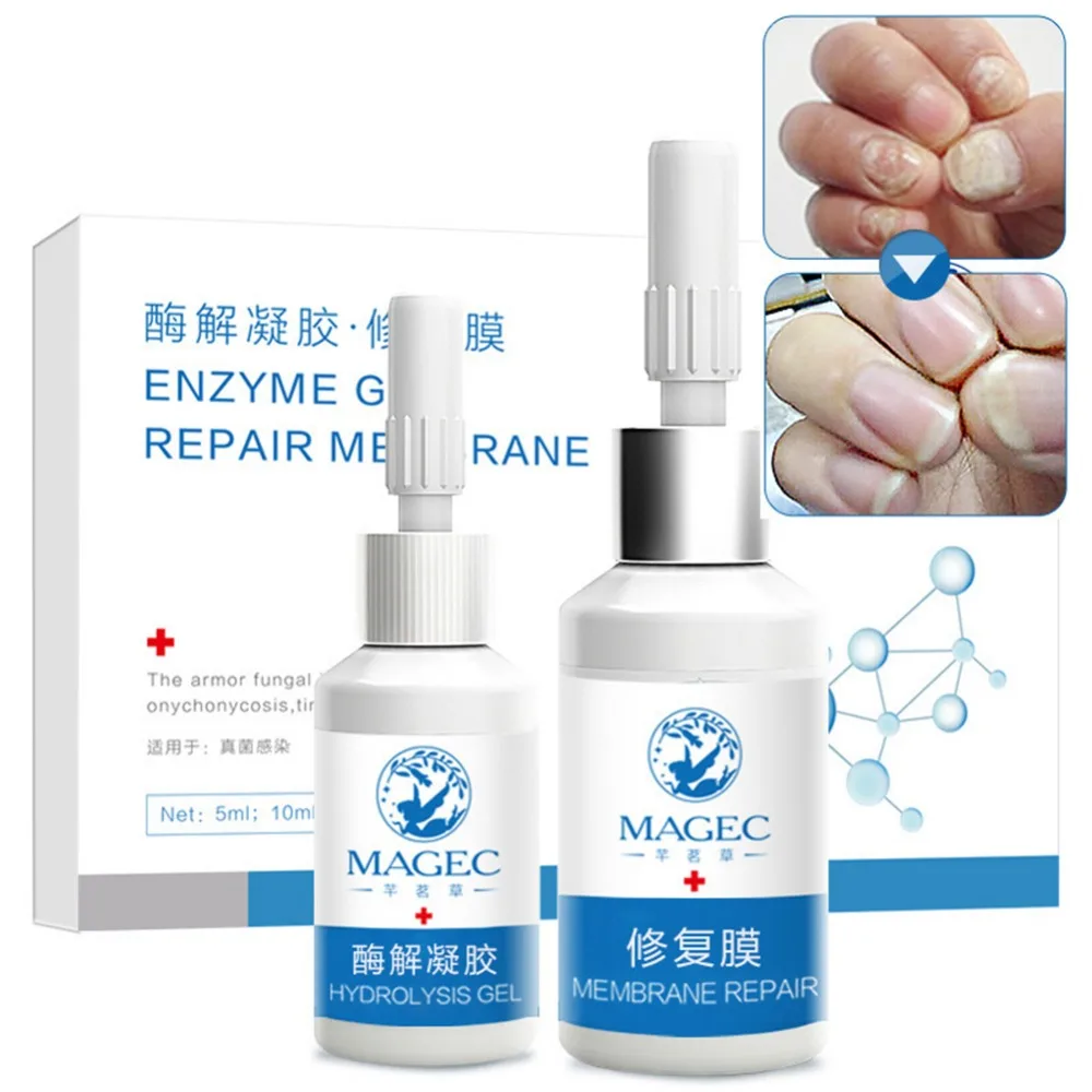 Onychomycosis Treatment Set Sterilization Eliminate Nail Fungus Toe Repair Essence | Красота и здоровье