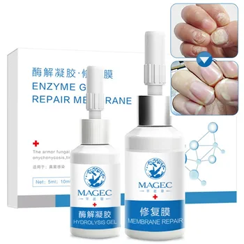 

Onychomycosis Treatment Set Sterilization Eliminate Nail Fungus Toe Nail Repair Essence