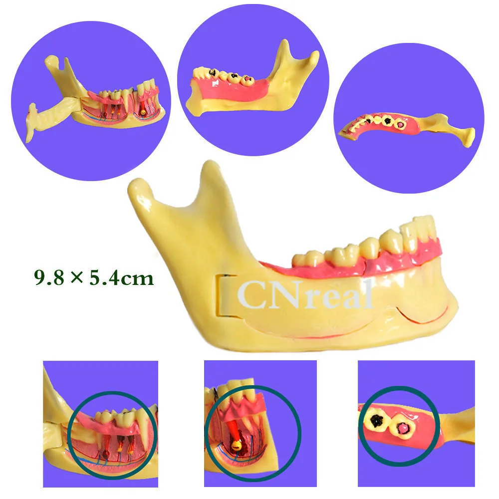 1 шт. мандибль зубы Патологии Модель для стоматологического обучения смолы