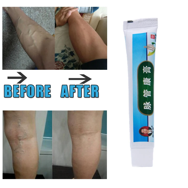 No box 3pcs/lot Chinese natural herbal medicine for treating varicose