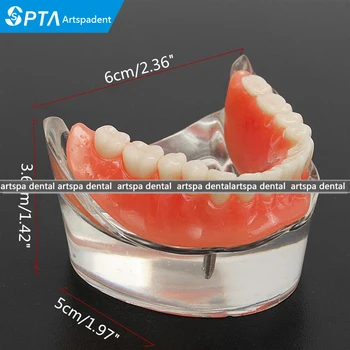 

generic implants with removable inferior overdenture Teeth Model