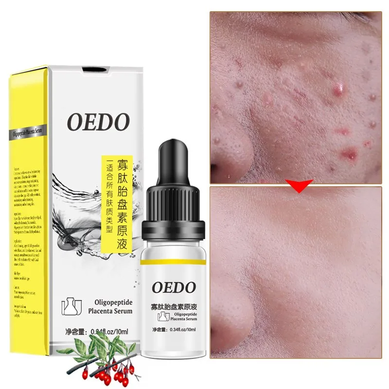 Олигопептид плацента акне Омолаживающая эссенция для кожи жидкость для удаления акне для восстановления кожи лица Отбеливание тонких пор