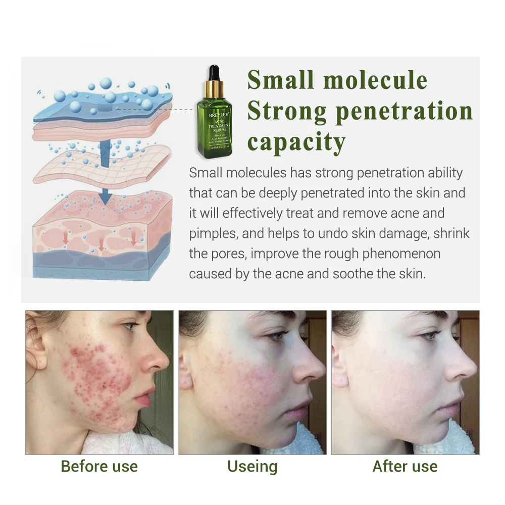 BREYLEE Tea Tree Acne Pimple Patch Invisible Acne Stickers Treatment Acne Face Cream Repair Acne pimple 5