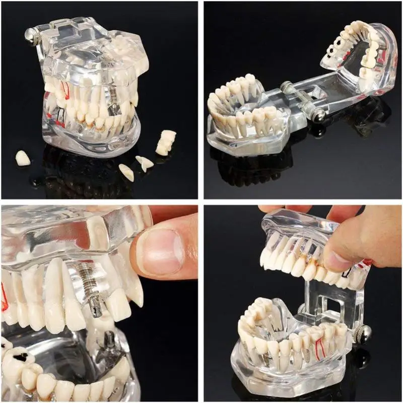 1 шт. зубной имплантат, зубная модель с реставрационным мостом, зубной Стоматолог для медицинской медицины, стоматологический тест на лечение