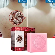 Мыло розы отбеливающая основа отбеливание кожи Kojic кислота ручной работы осветляющие прыщи, акне уход за лицом чистая ванна для мытья тела Savon L
