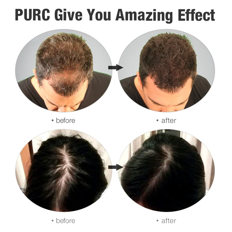 Горячая Распродажа эссенция для быстрого роста волос масло для лечения выпадения волос помощь для роста волос уход за волосами натуральные ингредиенты Ремонт 20 мл