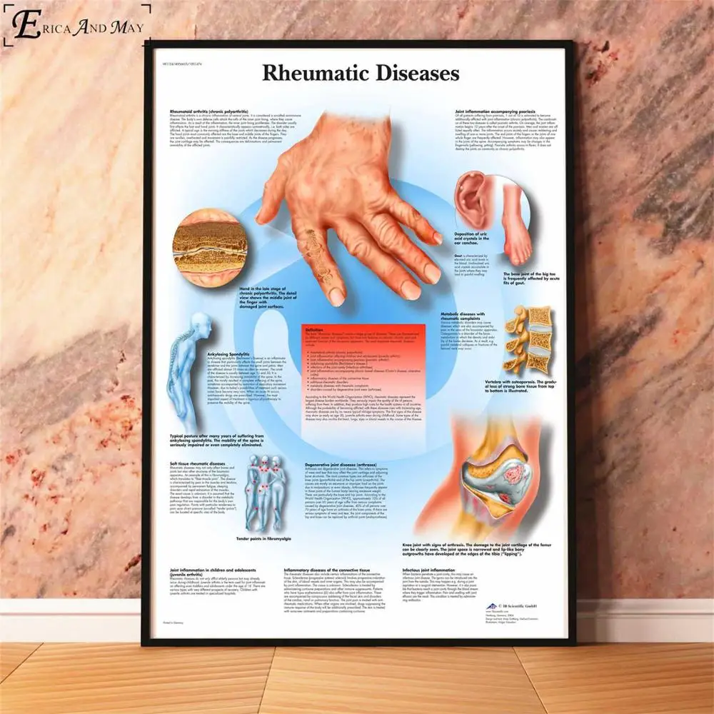 Анатомия болезни патологии диаграмма картина, печатный плакат декоративные настенные картины для комнаты без рамки украшения дома аксессуары - Цвет: Rheumatic Diseases