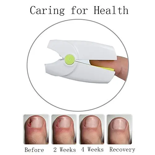 

Nail Cleaning Laser Device Nail Fungus Treatment Nail Fungus Remover Yellow Fungi Nail Solution