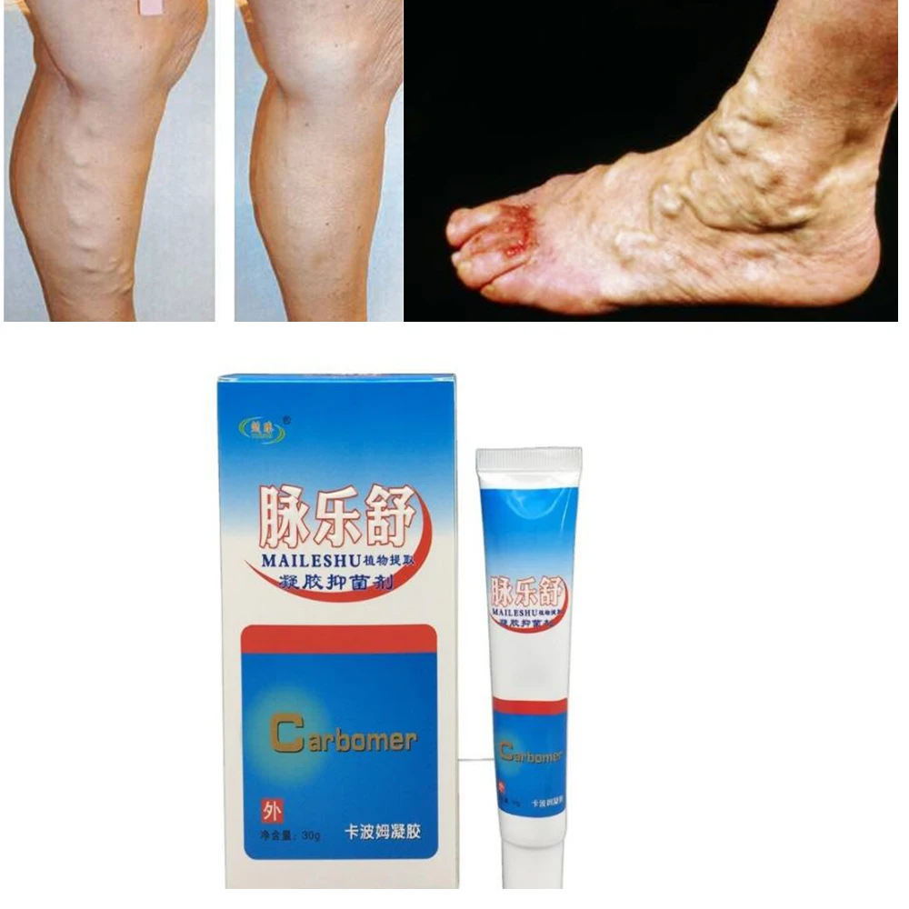 

5Pcs Leg Swelling Cream Varicose Veins Pain Varicose Veins And Spider Veins Natural Veins Sock 100% Herbs Original Patches D083