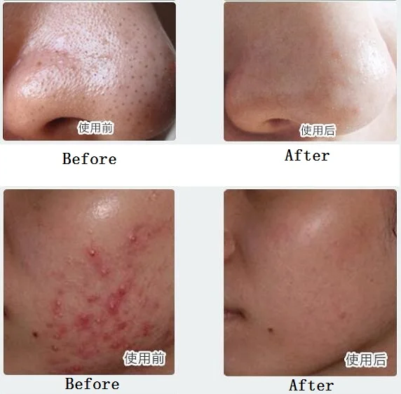 peeling cicatriz acne