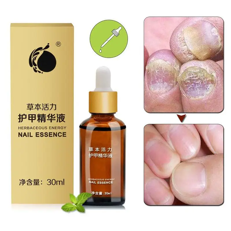BellyLady Stop Nail Fungus Treatments Anti Infection Nail Whitening Toe