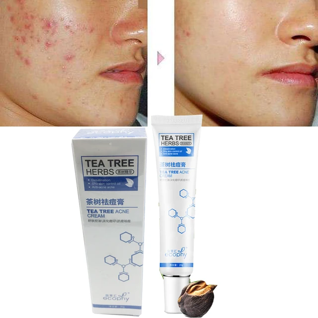 Tea Tree Extract Against Black Dots Face Cream Scar Removal Facial Blackhead Acne Treatment