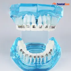 Стоматологический ортодонтический модель зубов с металлическими кронштейнами/модель зубов M3001