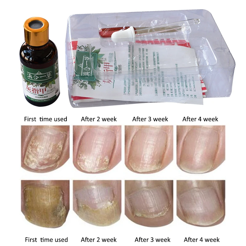 1 упаковка крем против грибка ногтей Paronychia лечение ног для удаления грибка для ногтей мазь Пальчиковый гриб китайские травы медицинский крем