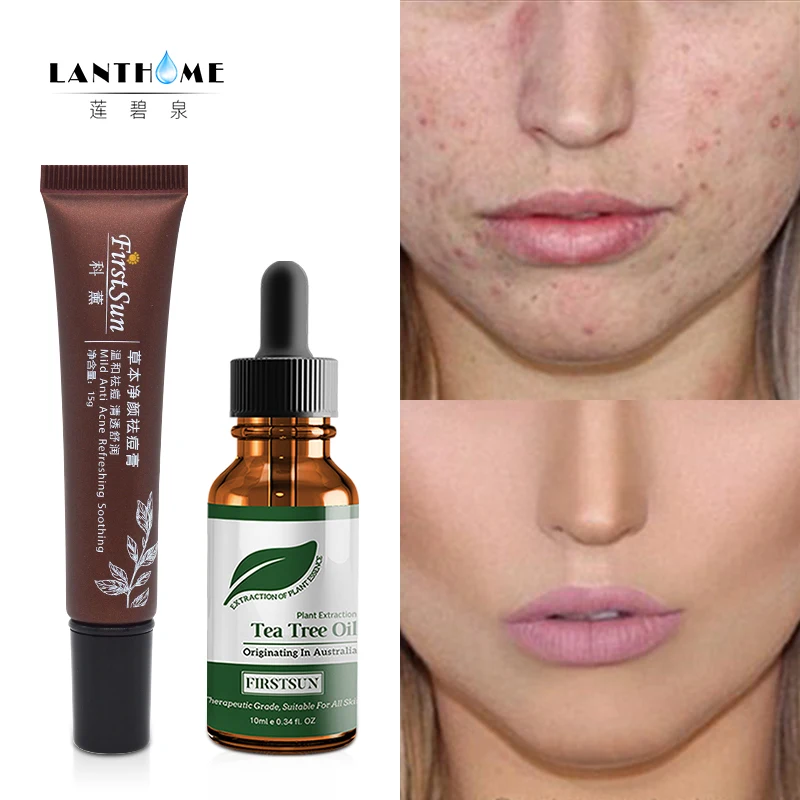 

Face Acne Cleaning Cream Skin Care Remove Repair Comedone Pimple Acne Scars Quickly Face Acne Cream Remover Anti Acne Treatment
