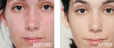 GLYCOLIC ACID BEFORE & AFTER