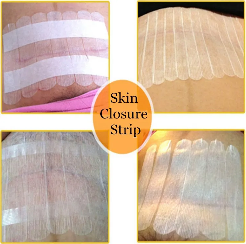 2 сумки, закручивающая кожу полоса, медицинская хирургическая клейкая лента, нет необходимости в шве кожи, стерильная раневая повязка, послеродовой ремонт ран