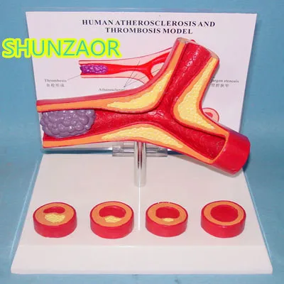 

Atherosclerosis Vascular model Thrombosis model Human vascular model
