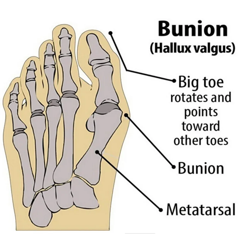 1 пара Hallux вальгусный антимозольный гель рукав устройство облегчение боли в ногах Уход за ногами стельки для обуви ортопедическая большая коррекция носка