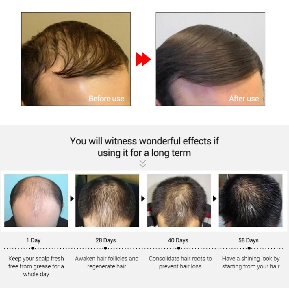 Мощная эссенция для роста волос, продукты для выпадения волос, жидкое эфирное масло, средство для предотвращения выпадения волос