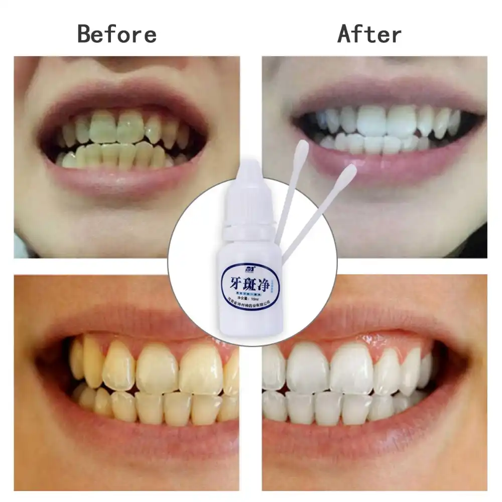 Clareamento dental