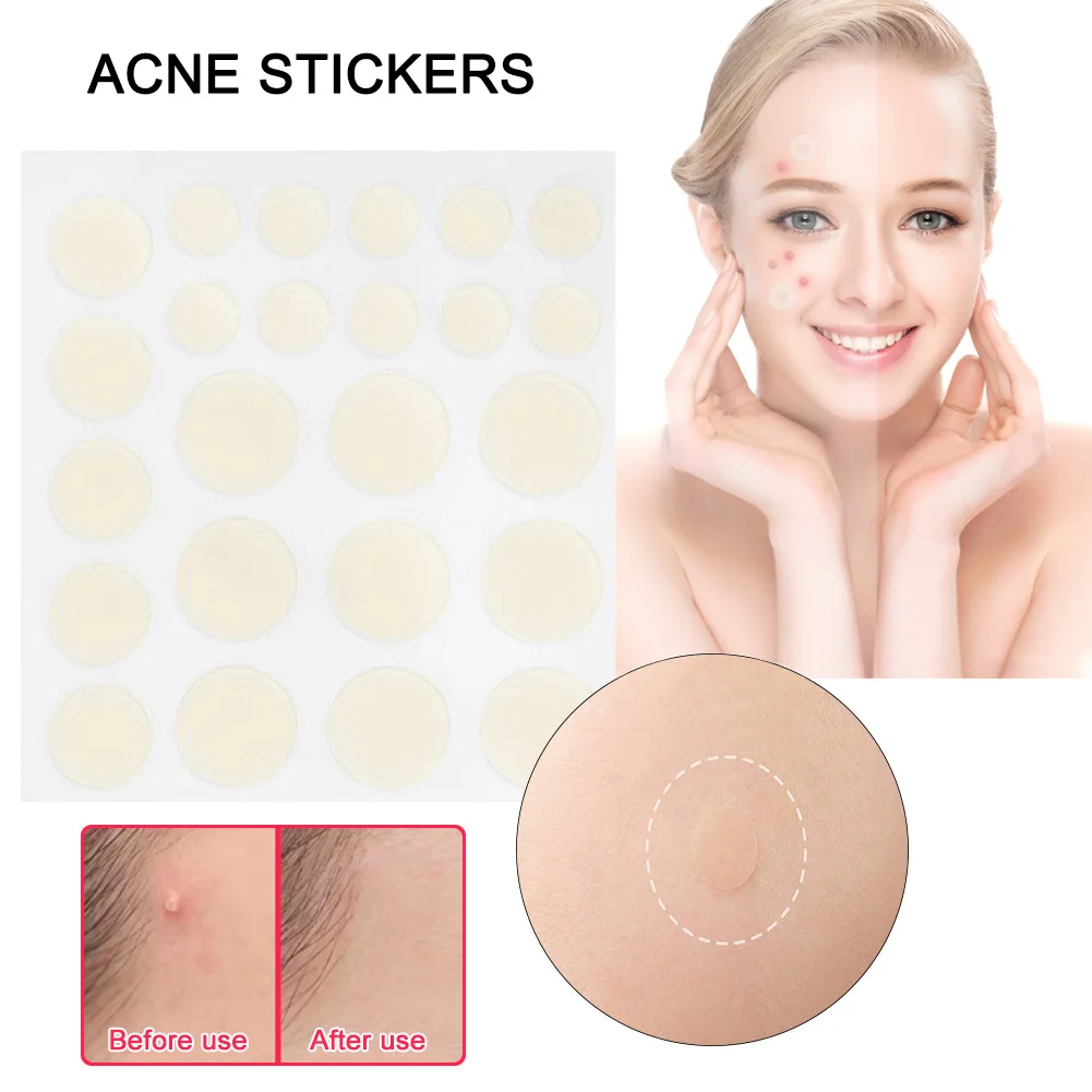 24 Patches Hemorrhoids Acne Treatment Paste Facial Care Acne Pimple 