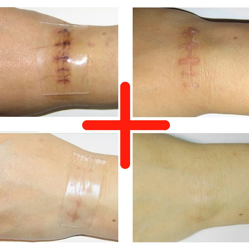 1pc free shipping silicone scar remove patch to remove scar trauma silicone sheets for keloids reviews