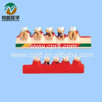 

BIX - L1010 Periodontal Disease Classification Model Dental Model MQ151