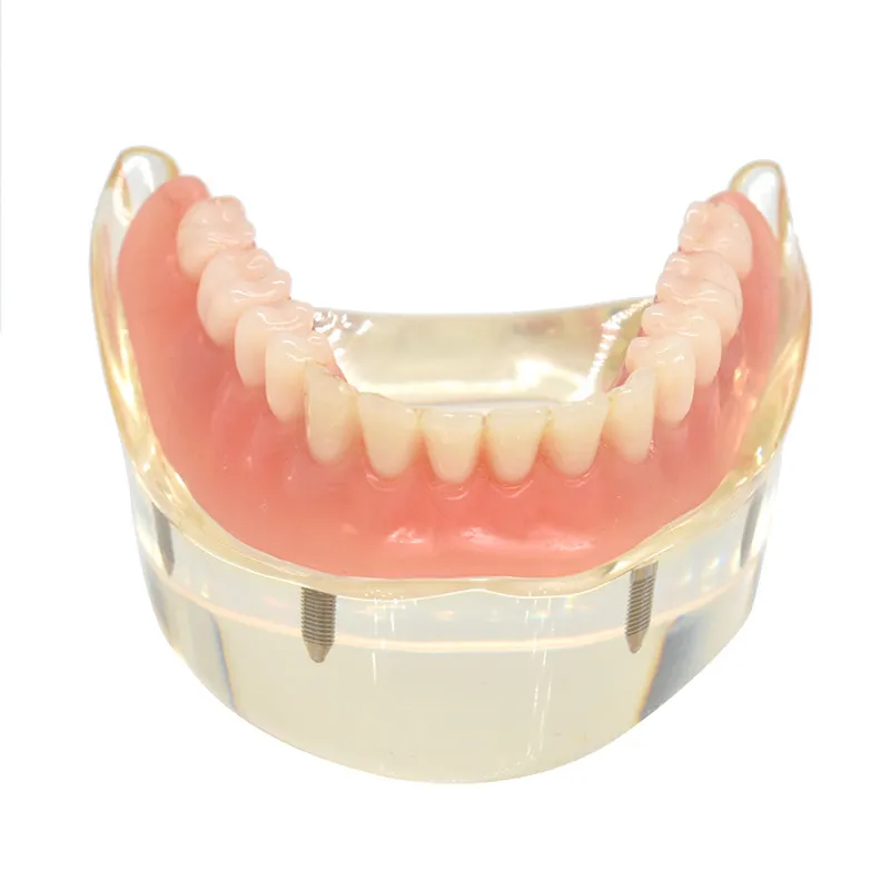 Dental Overdenture Teeth Model Removable Interior Mandibular Lower Teeth Model Mandibular with Implant for Tooth Teaching Study Dental Overdenture Teeth Model Removable Interior Mandibular Lower Teeth Model Mandibular with Implant for Tooth Teaching Study