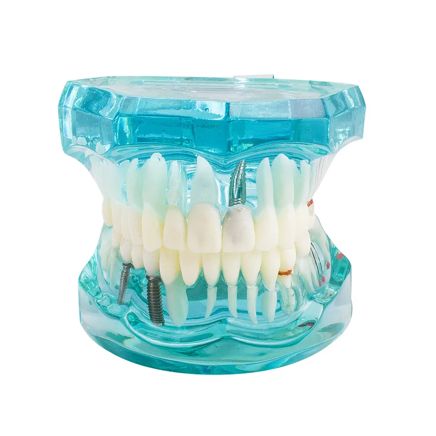 Стоматологическая Студенческая Стоматологическая Исследование Зуб Прозрачный взрослый патологические зубы модель подходит для взрослых