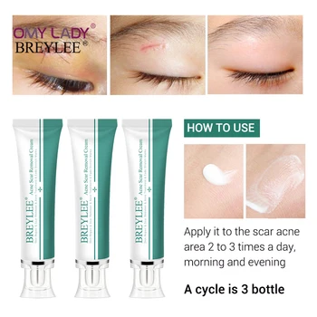 

BREYLEE Acne Scar Removal Cream Face Cream Skin Repair Skin Care Scar Acne Treatment Remove Stretch Marks Whitening Cream