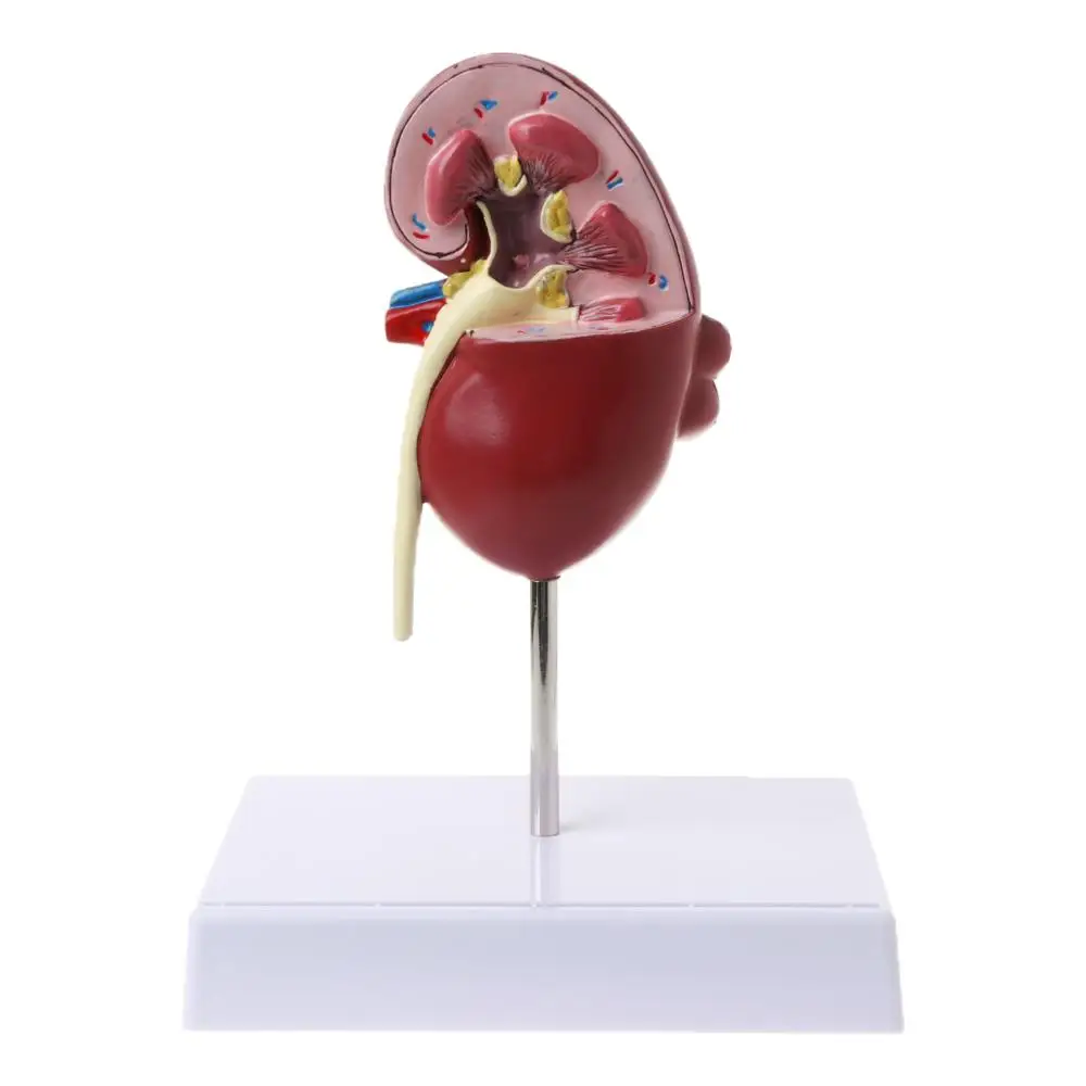 

Life Size Kidney Diseased Model Anatomical Anatomy Diseased Pathological Stone Organ MTeaching Supplies FOR Medical Science