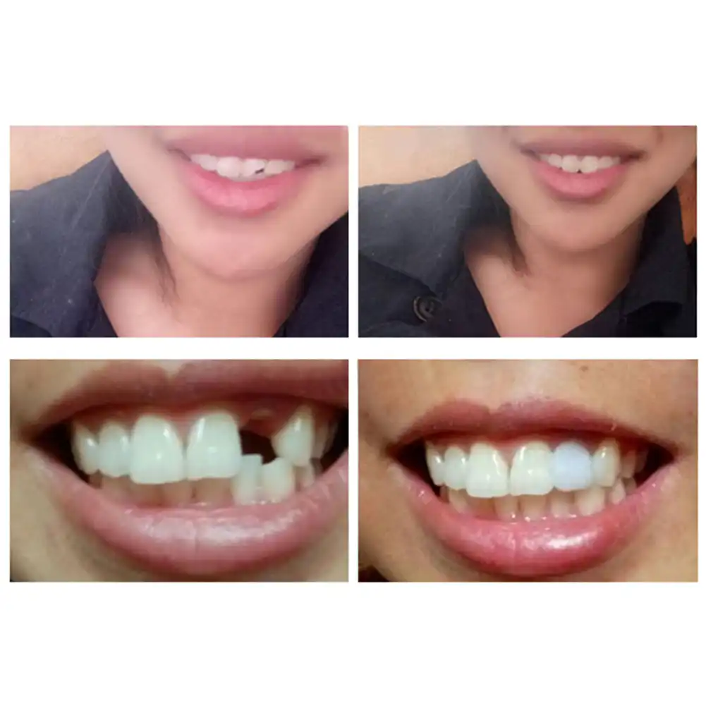 Diy Tooth Filling Repair / Temporary Tooth Filling Material Temp