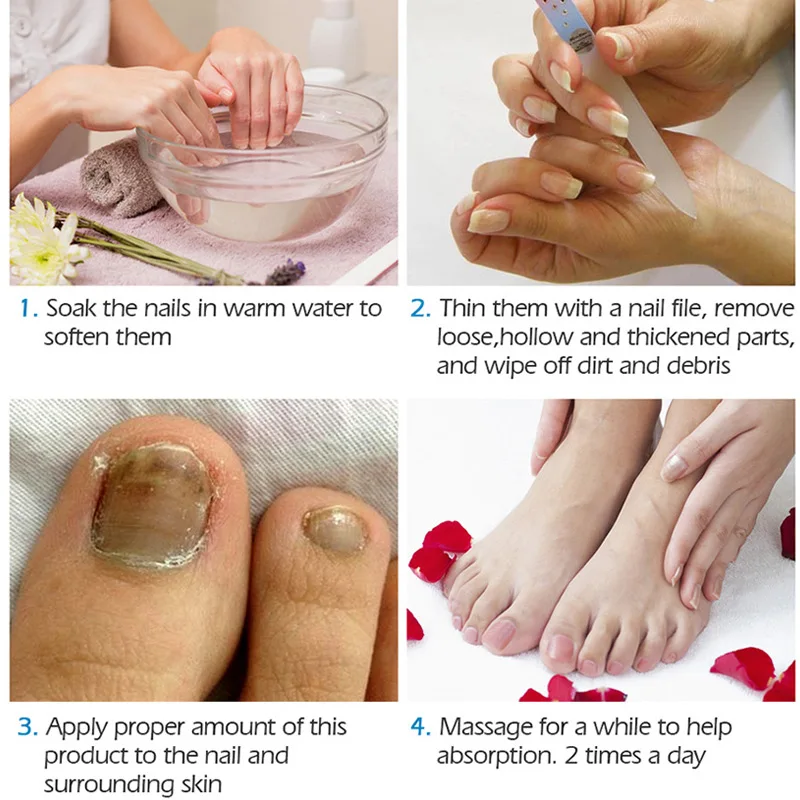 Nail Repair Cream Fungus Treatment Onychomycosis Removal Nail Toe Repair Cream OA66