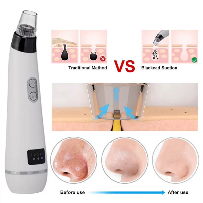 Buy ROSALIND Acne Blackhead Remover Facial Vacuum Pore Cleaner Face Skin Care Pimple Remover Nose Comedo Suction Black Spot Cleaner