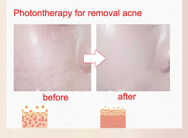 removal acne
