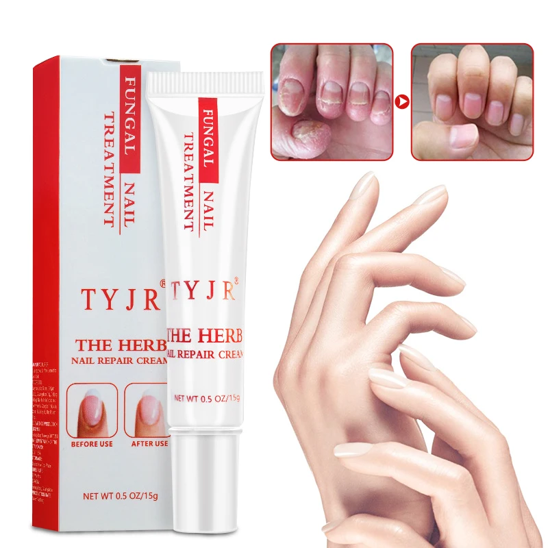 Best Fungus Nail Treatment Cream Onychomycosis Paronychia Anti Fungal