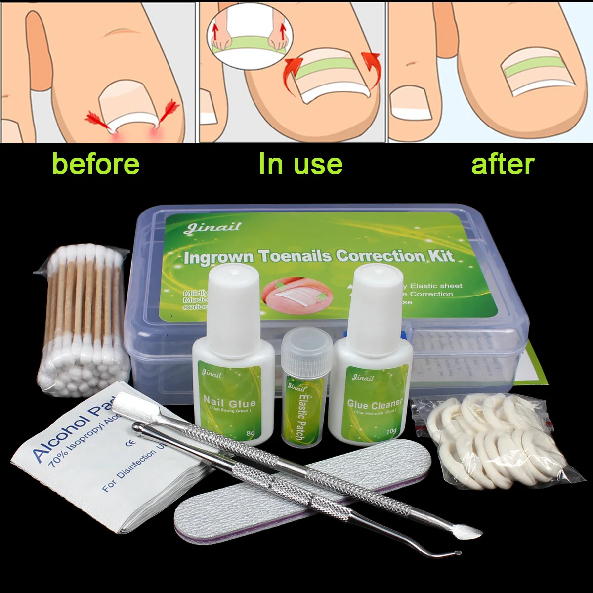 Healthy nails Standard 36pcs kit for serious Ingrown Toenail