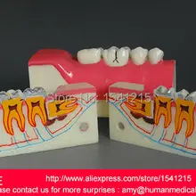 Зубные Патологии Модель анатомического зубов Модель зубные, после нижний правый зубной ткани разложения MODEL-DEN052
