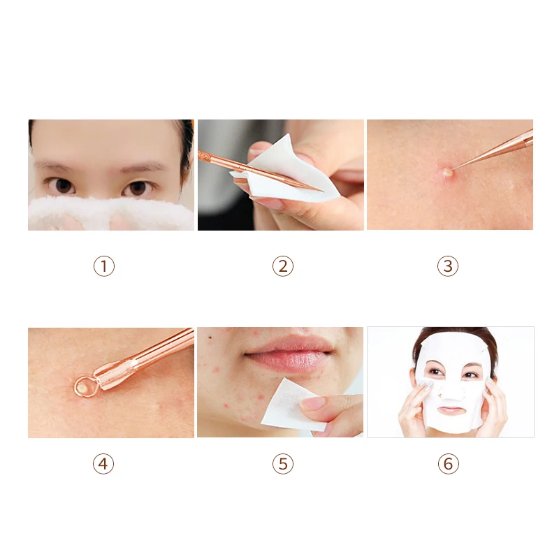 acne
