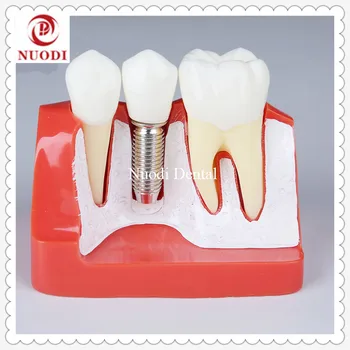 

4x Impalnt Tooth Model/Dental Implant Bridge Model/Implant fixture Model/Dental Education model Removable implant crown